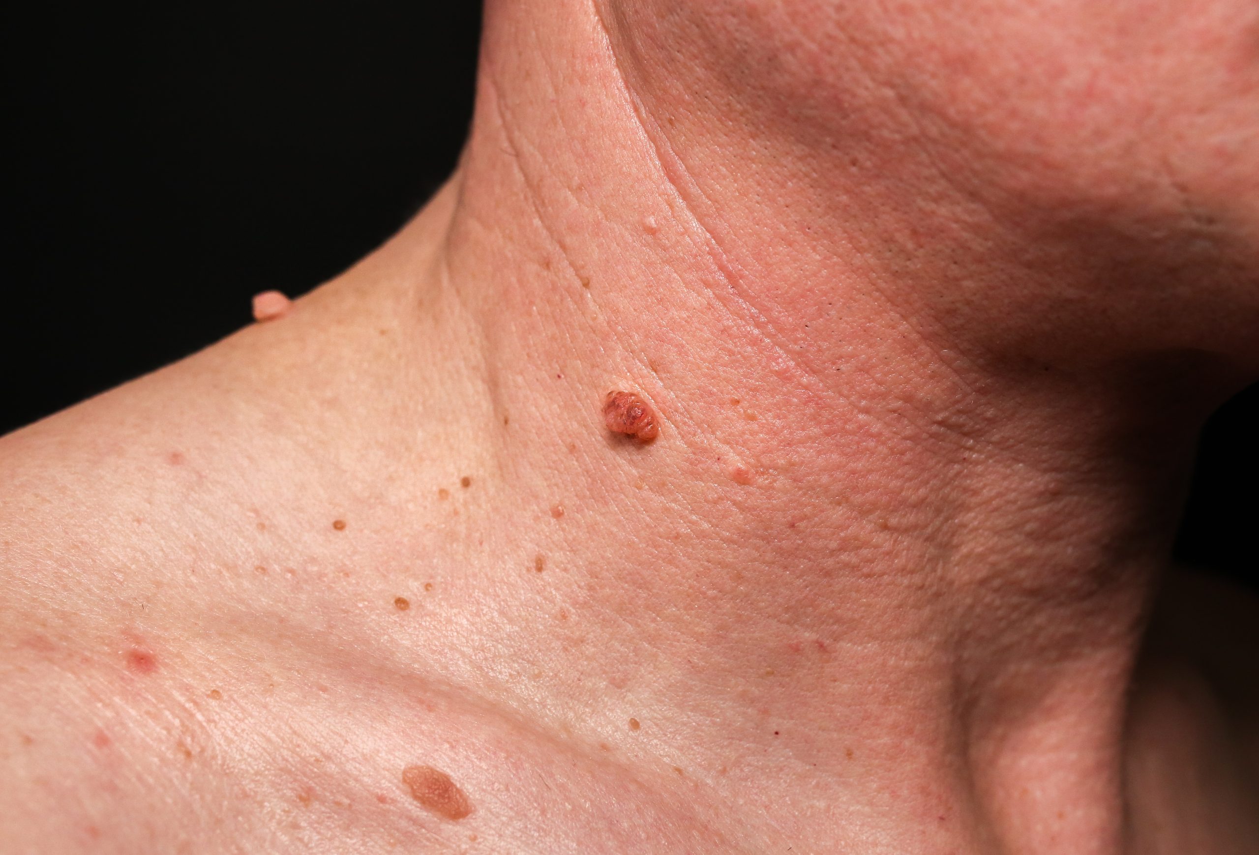 What Causes Skin Tags?