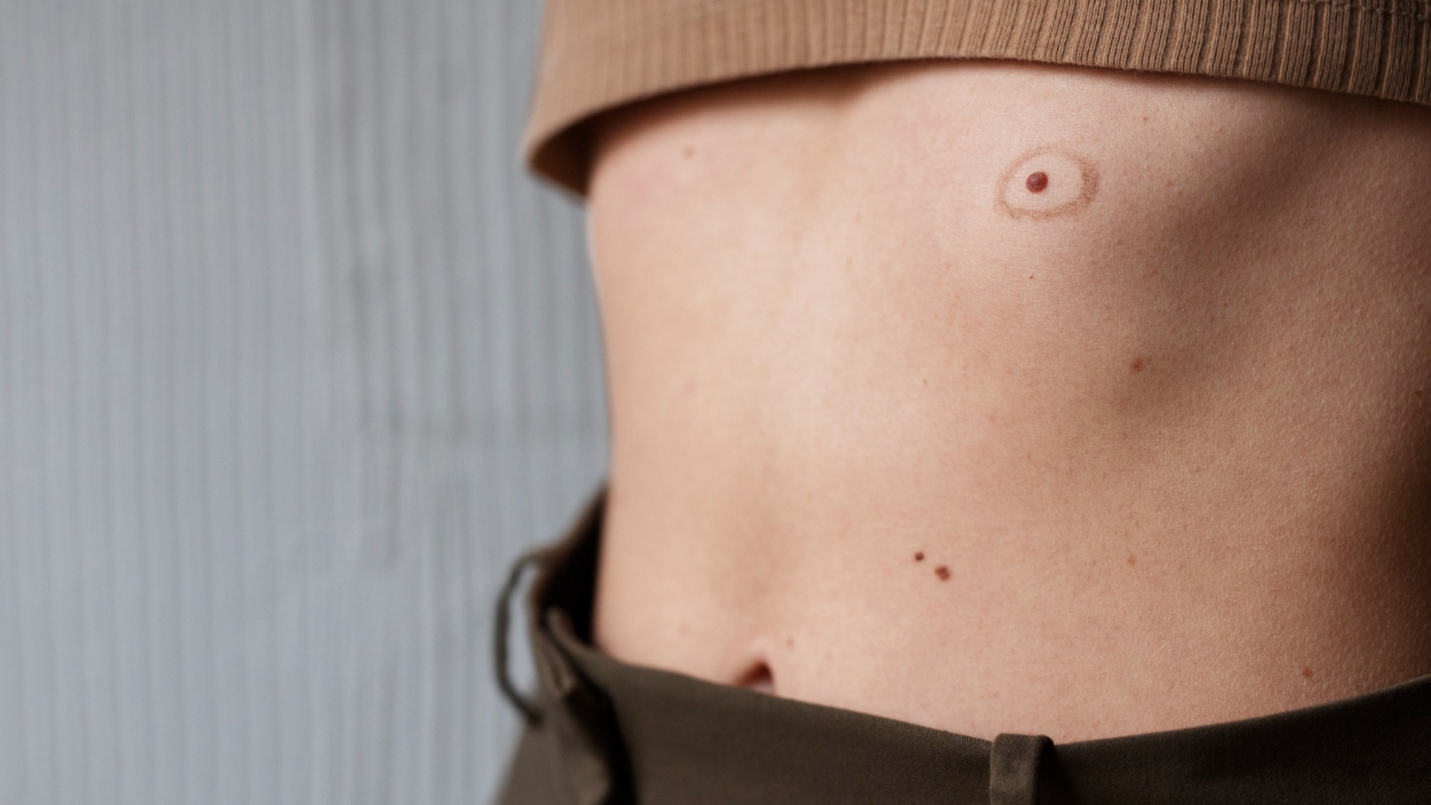 check moles for skin cancer