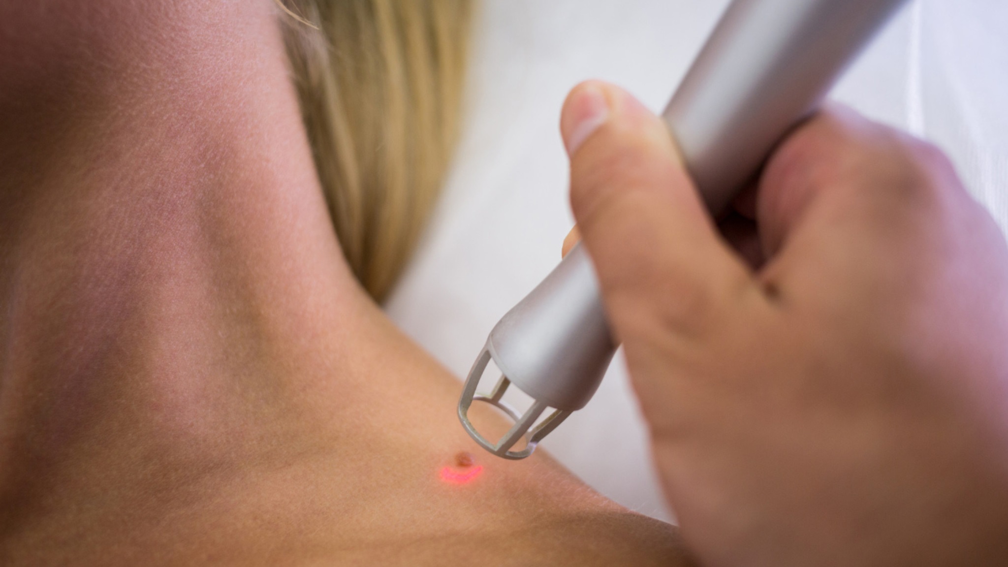check moles for skin cancer