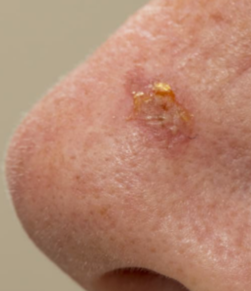 Sun-Damaged Skin Treatment in Milton Keynes