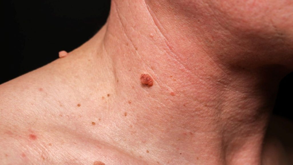 are skin tags harmful