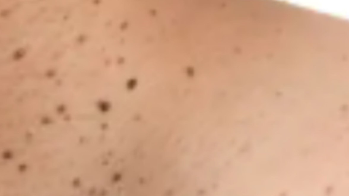 skin tag removal mk