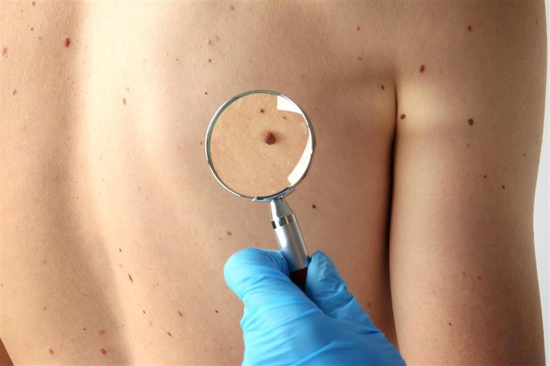 What to expect during skin tag removal