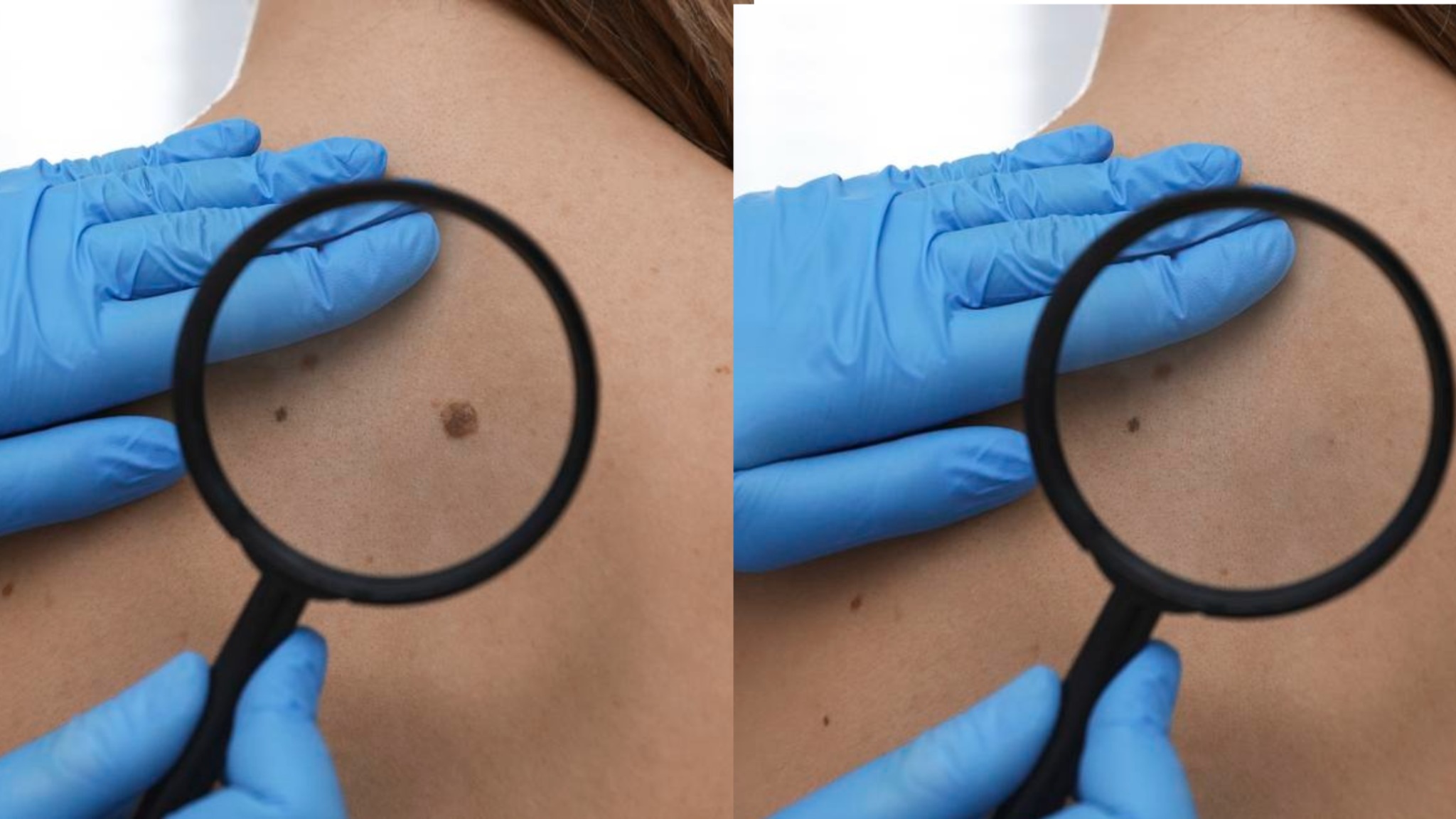 What Happens After Mole Removal