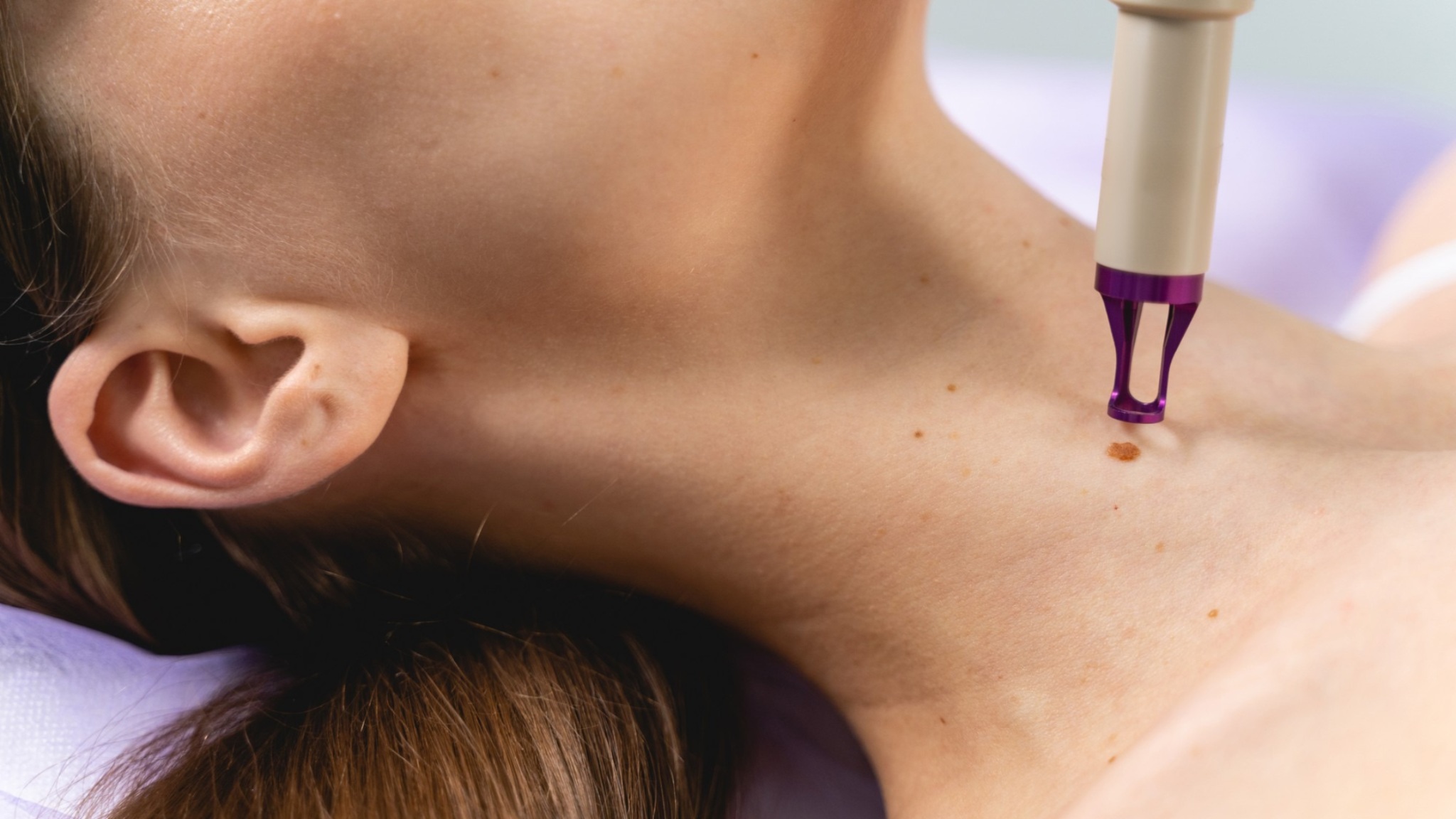 mole removal procedure