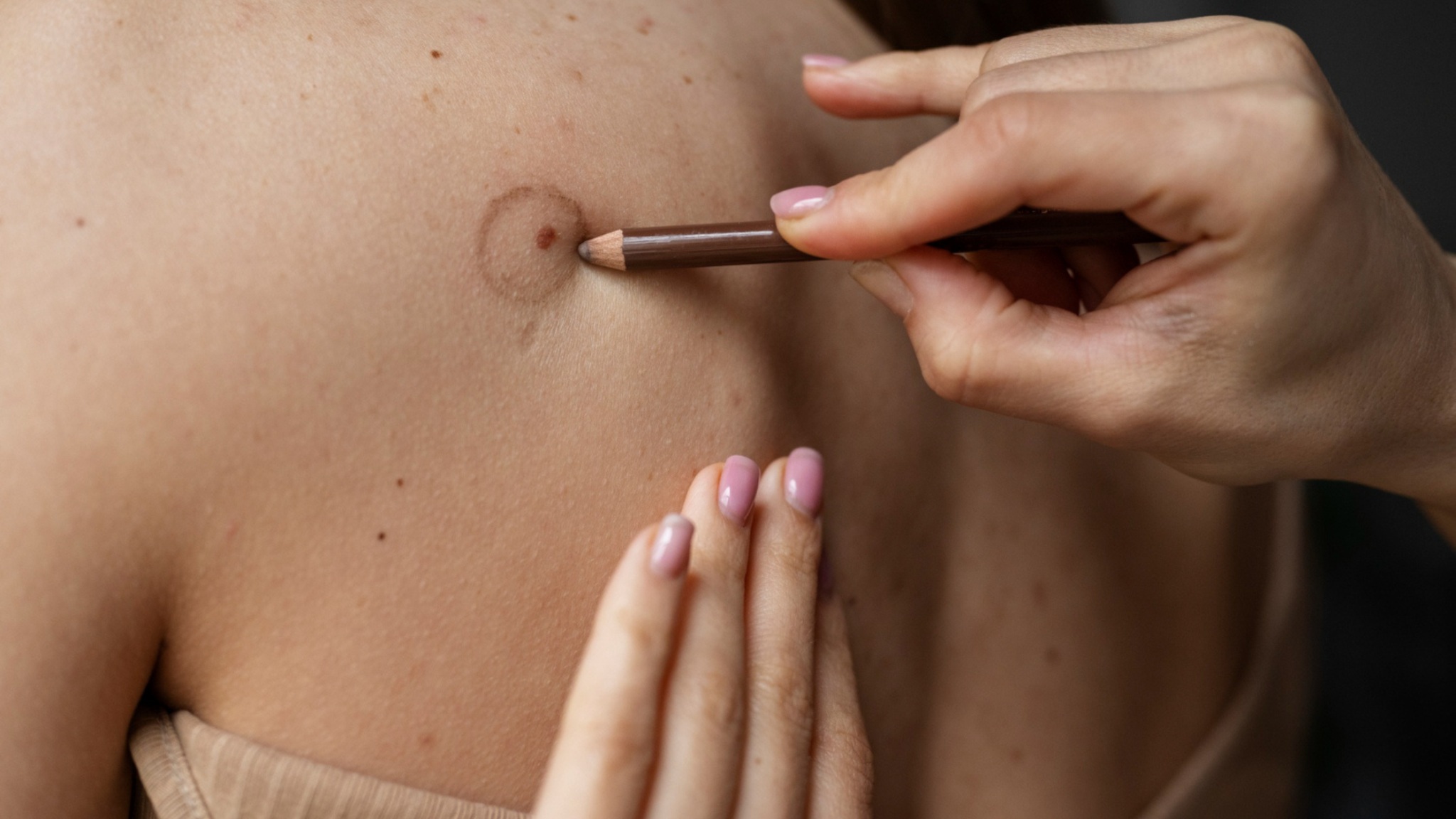 what happens during the mole removal