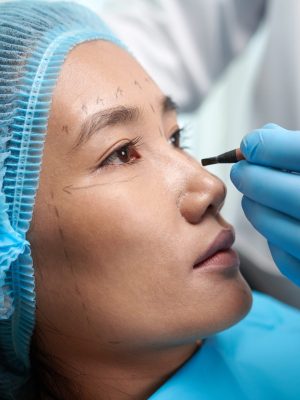 Closeup image of surgeon drawing lines on face of female patient
